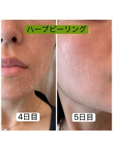 リラ(RILA)/ハーブピーリングダウンタイム