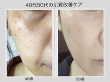 【たるみ改善】老化にブレーキを！たるみ・シミ改善なら美顔筋！