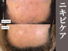 マヴィ くずは店(MavY.)/長年お悩みのニキビケア