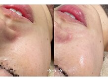 フローラスキン 恵比寿Amour店(florasKIN)/肌質改善(水光注入)