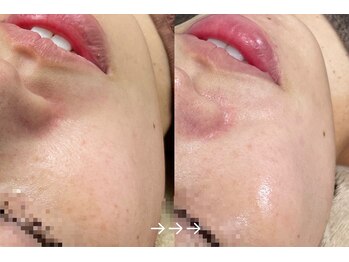 フローラスキン 恵比寿Amour店(florasKIN)/肌質改善(水光注入)