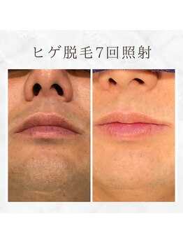 ボゴス(BOGOSS)/ヒゲ脱毛7回照射