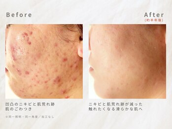 メレ(mele)/20代赤み/ニキビケア・毛穴