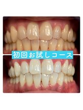 ホワイトニングルーム 横浜店(Whitening Room) 専門店の 実力