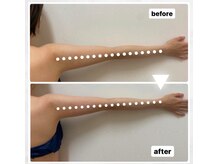 アクア(AQUA)/ハイパーナイフ＆シェイプ痩身