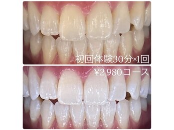 ホワイトニングルーム 横浜店(Whitening Room)/ホワイトニング/横浜