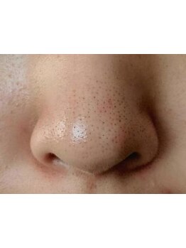 毛穴ケアをしたい