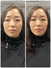 長寿鍼灸院 長寿整骨院/美容鍼50本の効果★小顔効果