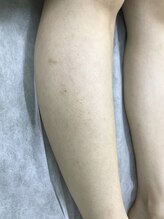 ナノハナ/鹿沼市の全身脱毛のナノハナ