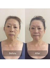 エスエスカイロビューティー(SSCHIRO beauty)/肌ツヤ改善フェイシャル