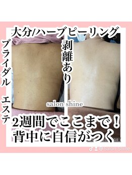 サロンシャイン(Salon Shine)/ブライダルでも大人気！背中ケア