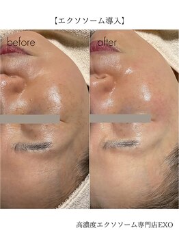 エクソ 吉祥寺(EXO)/エクソソーム導入の結果写真