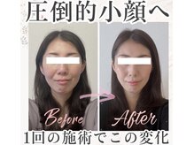 アシュネ(Axiune)の雰囲気(持続力が自慢!翌日に戻らず更にリフトアップ&小顔効果を実感♪)