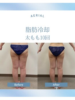 エアリアル 武雄店/脂肪冷却