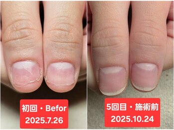 マニブルーム/初回と5回目　親指