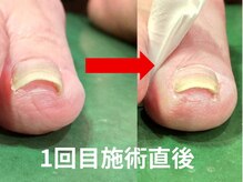 巻き爪1回目施術直後