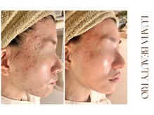 リオ(RIO)/肌育ケア途中経過