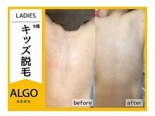 アルゴ 南茨木駅前店(ALGO)/【キッズ脱毛】