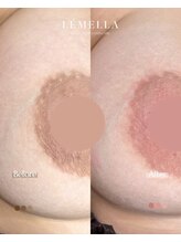エルビービュティーサロン(LB BEAUTY SALON)/【ルメラ乳輪】実績数関西1★