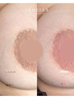 エルビービュティーサロン(LB BEAUTY SALON)/【ルメラ乳輪】実績数関西1★