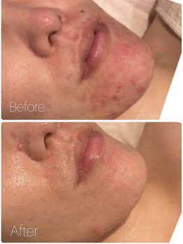 ルーヴェ(Luve)/陶肌トリートメント