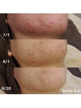 ビーピー 渋谷(b.p.)/顎ニキビケア