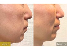 ルフレ(REFLET)/【事例3】Before/Afterたるみ