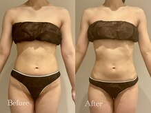 エステティック ミュー(Esthetic MiEUX)/ブライダル痩身5回目