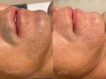 オンセ(once)/顔脱毛/全身脱毛