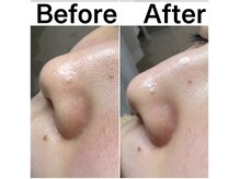 プルティティア 池下 今池 覚王山(Pultitia)の雰囲気(一回で綺麗に!毛穴洗浄プレミアムなら月一のメンテナンスで◎)