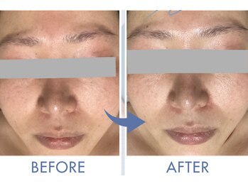 マカナ(Makana)/【ララピール】Before After