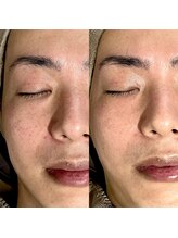 ミーエイト(Mii∞)/《エイジング・たるみ・毛穴》