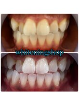 ホワイトニングショップ 大阪玉造店/Before&After美白ホワイトニング