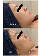 ブランシュール/炭酸カーボキシー×小顔タイト