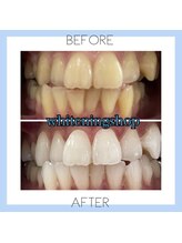 ホワイトニングショップ 芦屋店/お客様のビフォーアフター♪