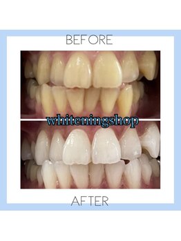 ホワイトニングショップ 芦屋店/お客様のビフォーアフター♪