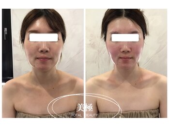 美極 銀座店/銀座/小顔コルギ/小顔矯正