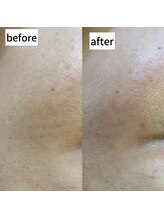 チアリー(Chiary)/フェイシャルワックス/顔脱毛