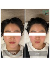 キュープ 前橋店(Qpu)/小顔頭蓋骨矯正＋オイルケア 1回