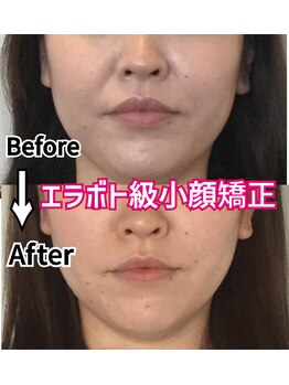 アコルデ 岡山問屋町(ACORDE)/小顔矯正ver.4