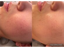 リラ(Lilas)/ハーブピーリング