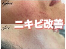 オーノ(Ohno)の雰囲気（【生涯の素肌管理サポート】マツヤニは肌質改善ができるワックス）