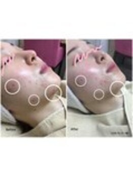 ラウレア 西条店(LAULEA)/ハーブピーリングBefore/After 