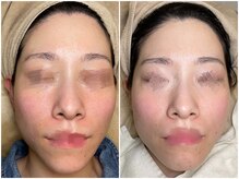 スターラッシュ(Star Lash)/全顔美肌脱毛1回施術前後