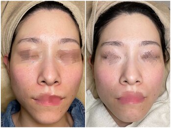 スターラッシュ(Star Lash)/全顔美肌脱毛1回施術前後