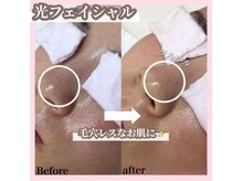 サロン(SALON)/光フェイシャル