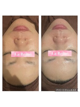 エステテックサロンラレーヌ 小山店(La Reine)/毛穴ツヤ肌でツルツル＆美白