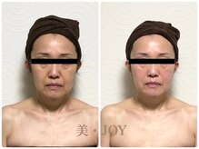 美 ジョイ(美 JOY)/小顔コルギ　施術例