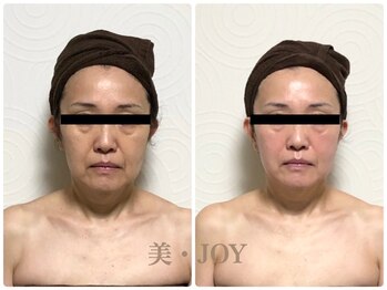 美 ジョイ(美 JOY)/小顔コルギ　施術例