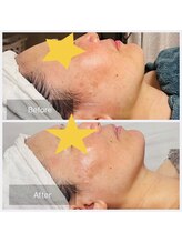 カノン(Kanon)/【美白】レモンボトル１回の症例